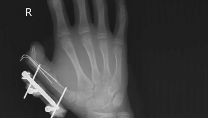 突然爆炸！这个常见保鲜品暗藏危险！