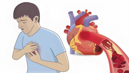 陈根：年轻人心梗发病率飙升15%，这一数据意味着什么？